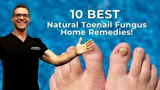#1 BEST Toenail Fungus Treatment? [Top 10 Home Remedies] 2024