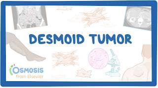 Desmoid Tumor (NORD) (2026 update)