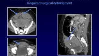 Cesarean Section US & CT of Acute and Chronic Complications