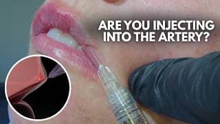 How to inject lips - Avoid the labial artery
